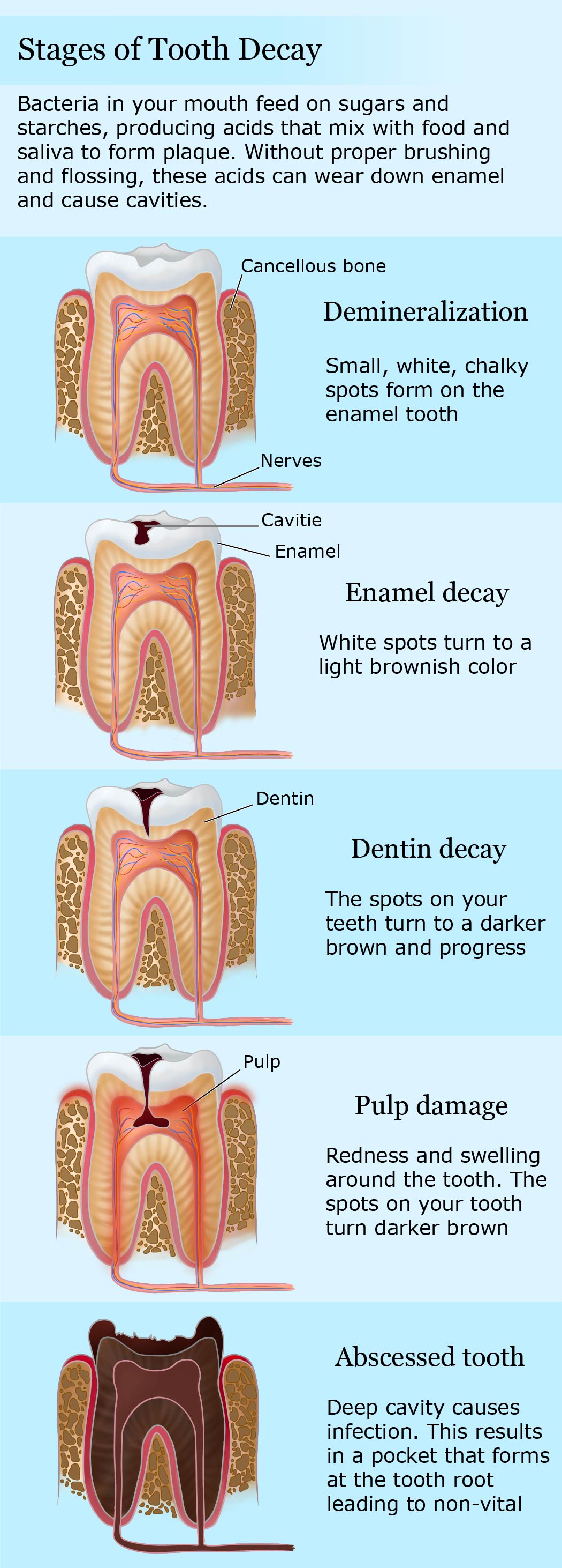 Tooth Decay Diagram